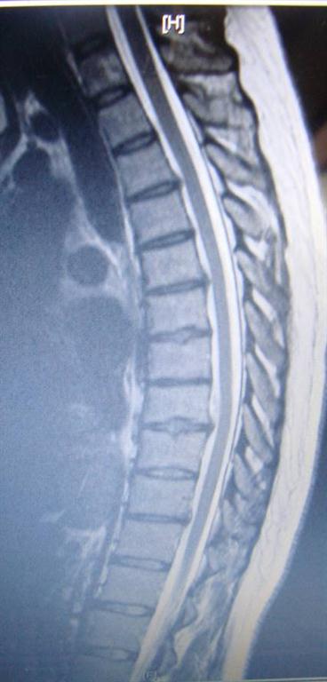 thoracic disc herniation treated by Vancouver chiropractor